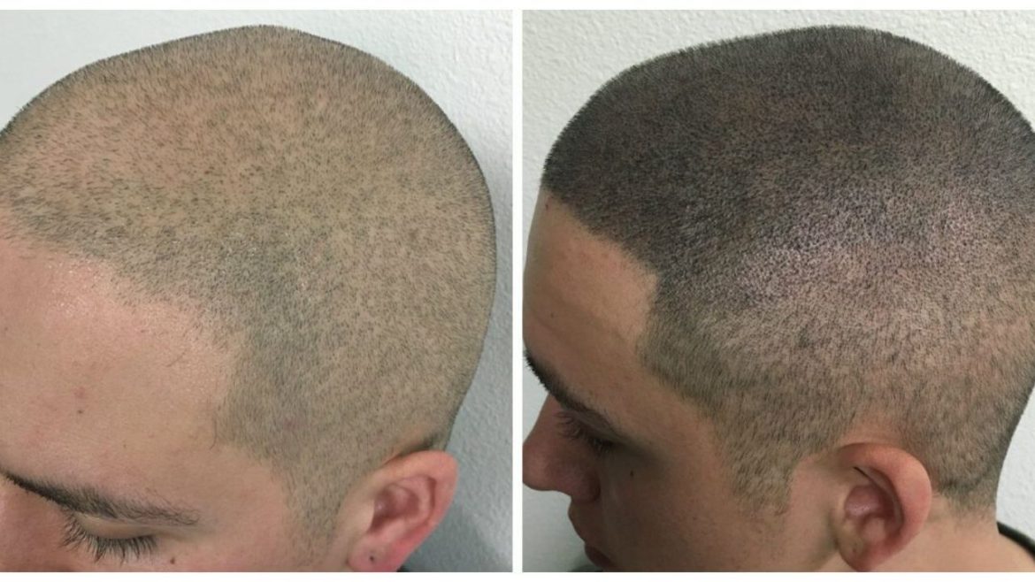 Revitalizing Confidence: Scalp Micropigmentation for Hair Loss